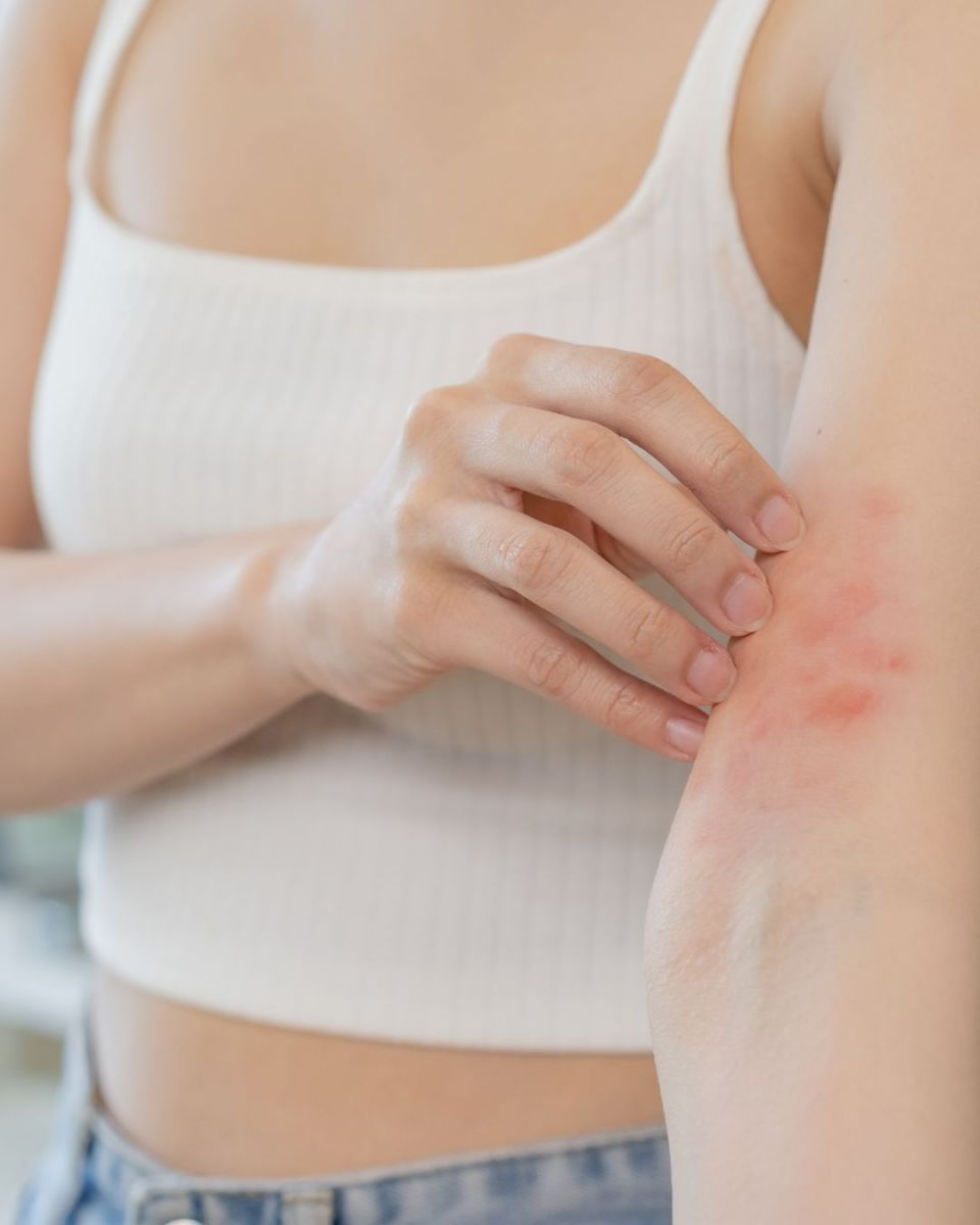 Bị kích ứng sau khi wax lông