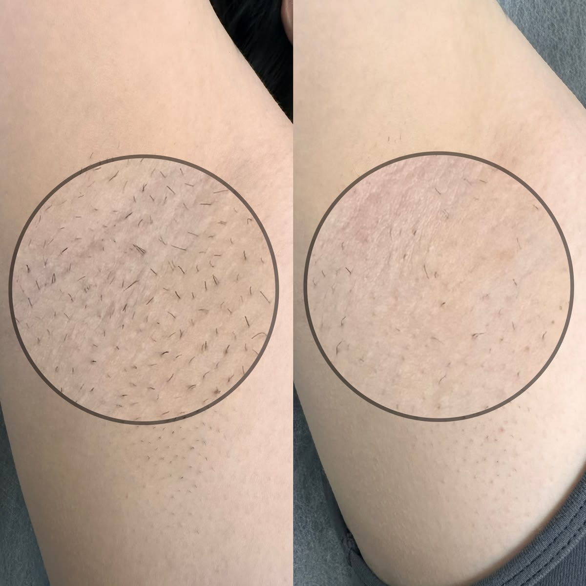 Lông mọc lại châm chích sau wax 