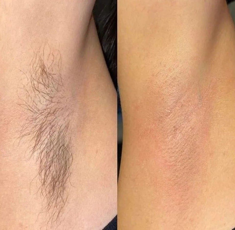 Sự thật về lông nách