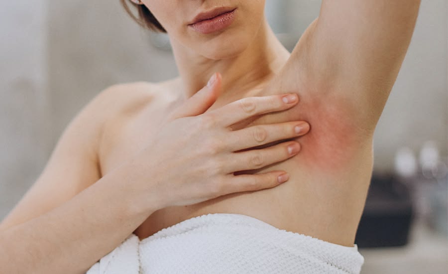 Nhựa thông bám chặt vào da gây đau rát
