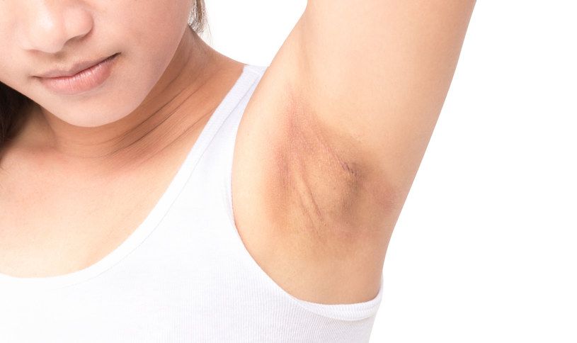 Gây thâm sạm nách và tổn thương nang lông sau cạo