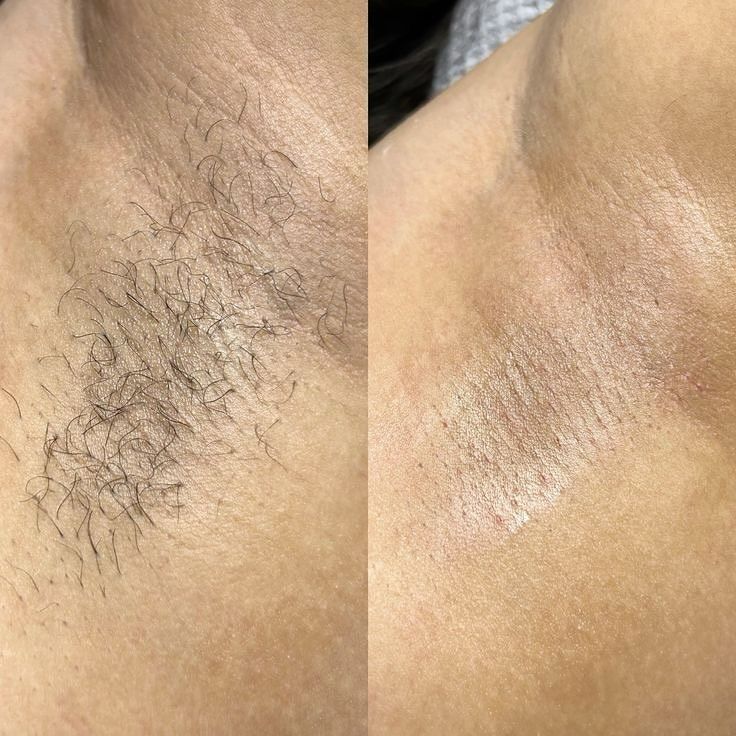 Wax nách để tự tin diện đồ đẹp đi chơi lễ
