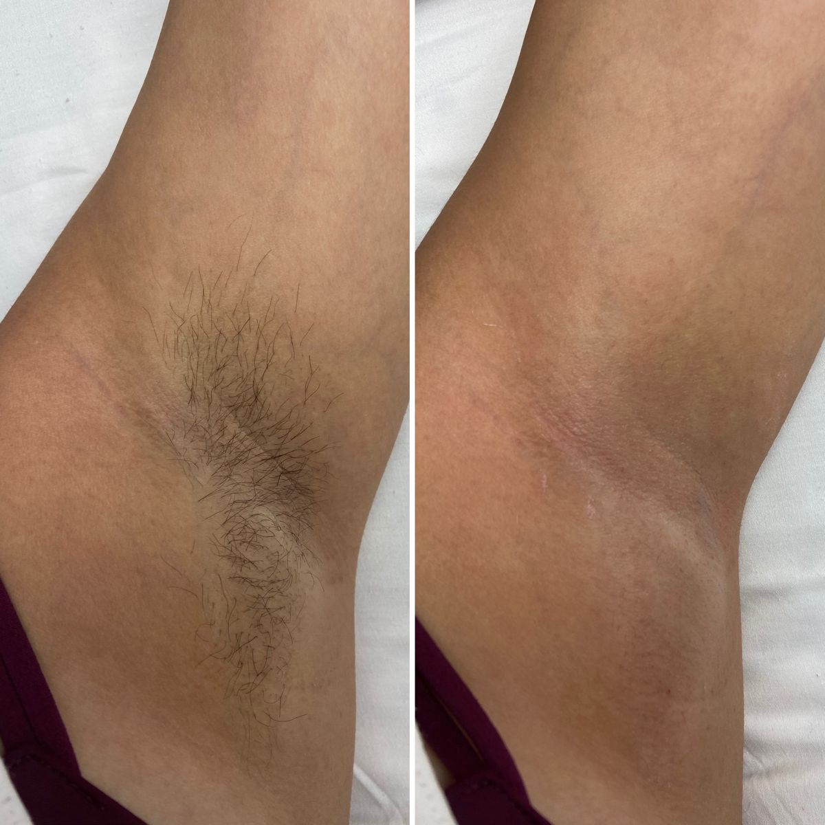Độ dài lông lý tưởng khi wax lông