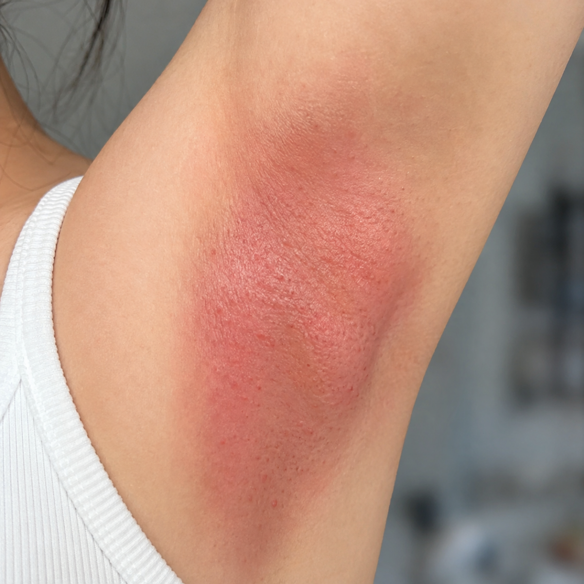 Nách bị đỏ sau khi giật nhiều lần