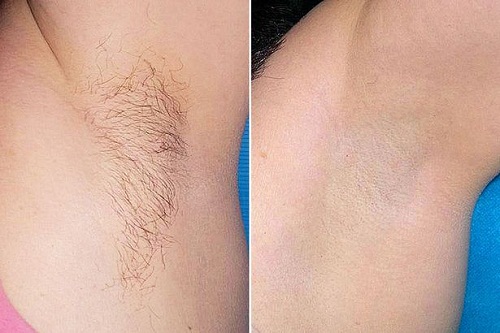 So sánh trước và sau khi wax lông