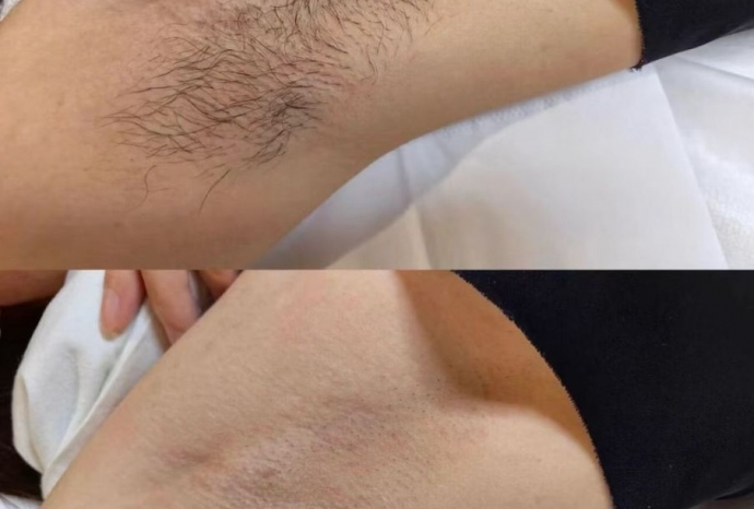 Vì sao wax nhiều lần vẫn không sạch lông? Nguyên nhân ít ai biết!