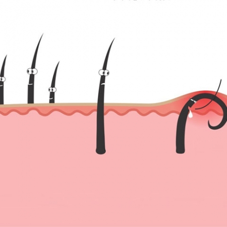 Wax lông có bị viêm nang lông không?
